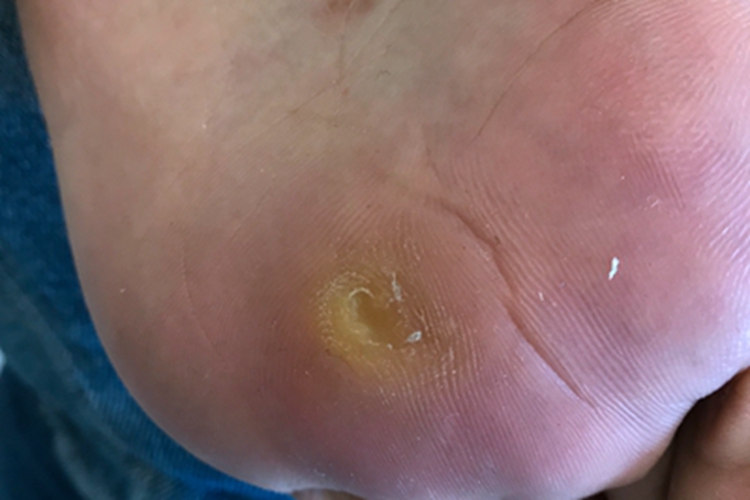 胼胝脚底皮肤粗糙图