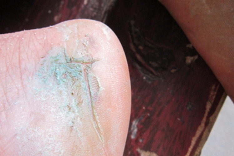 足癣皮肤发绿图