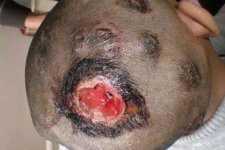 小孩脓癣头烂图