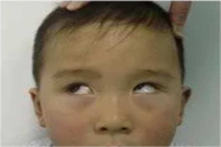 获得性上斜肌麻痹图