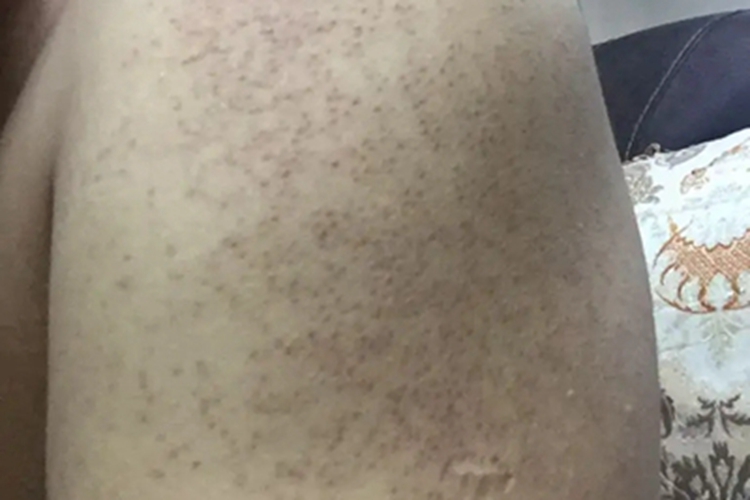 持久性色素失禁症黑斑图