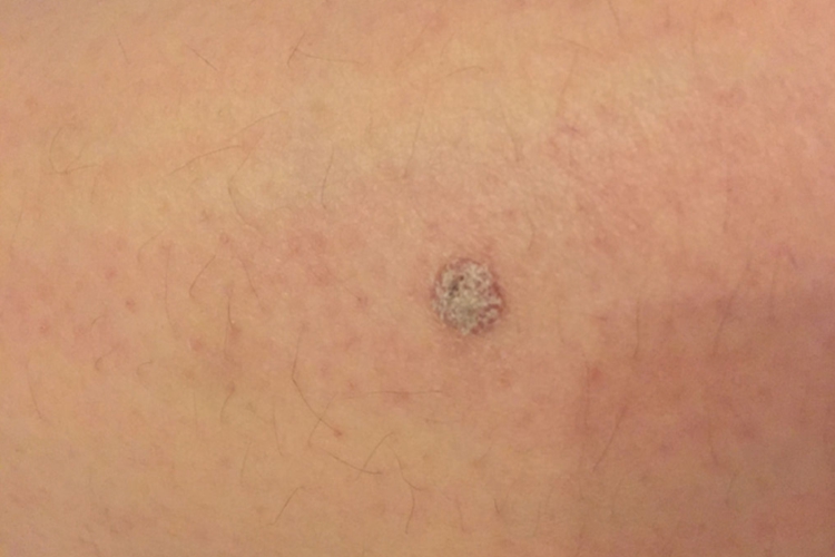 大腿内侧长疣图