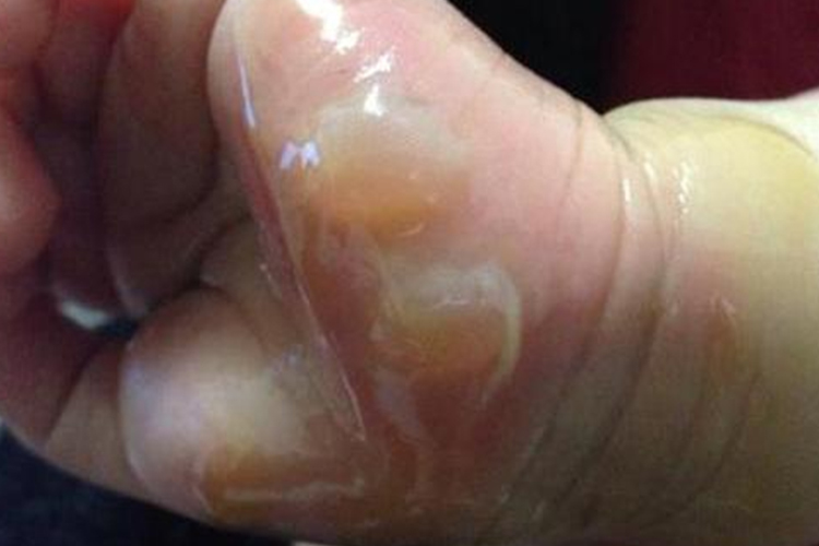 手部浅Ⅱ度烫伤水疱图