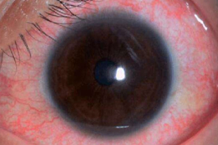 苯中毒充血图 苯中毒充血图