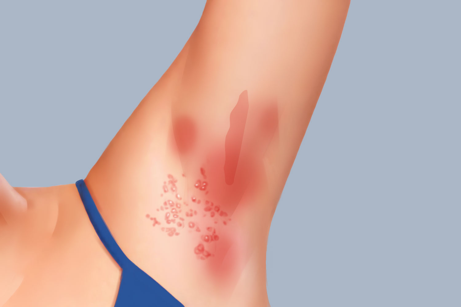 腋下毛囊炎图 腋下毛囊炎图