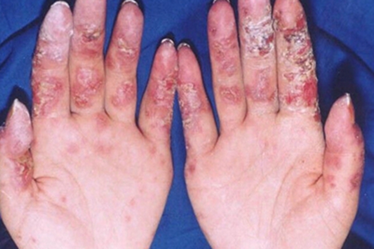 冻疮样红斑狼疮结痂图