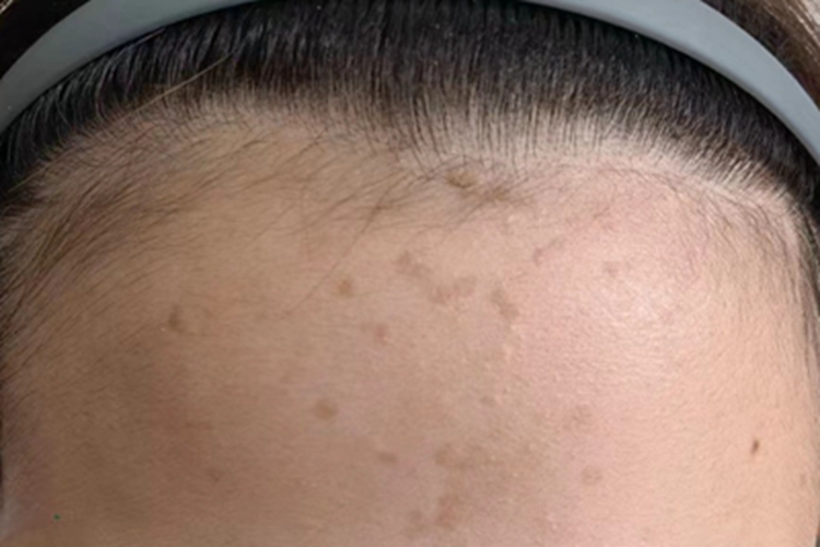 扁平疣脑门有淡褐色小斑点图