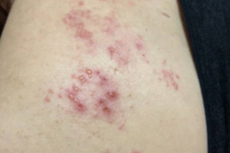 柯萨奇湿疹腿部成片小水疱图