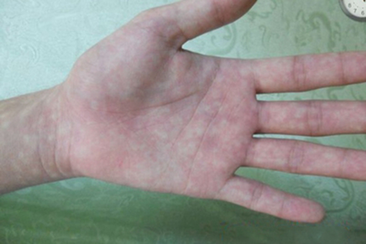 马歇尔-怀特综合征手掌白斑图 马歇尔-怀特综合征手掌白斑图