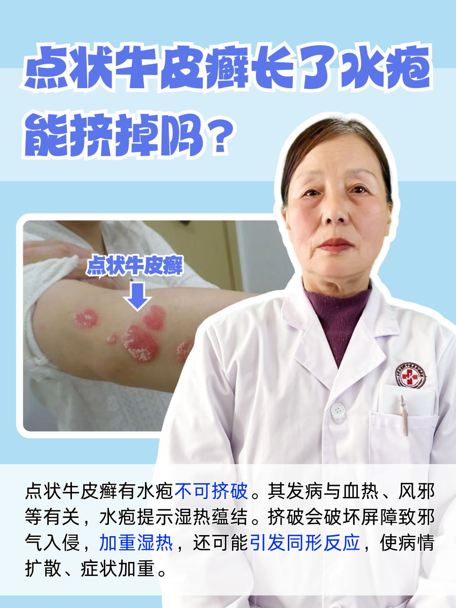 点状牛皮癣长了水疱，能挤掉吗？