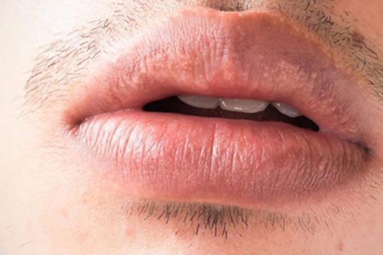 皮脂腺异位症嘴唇白点图