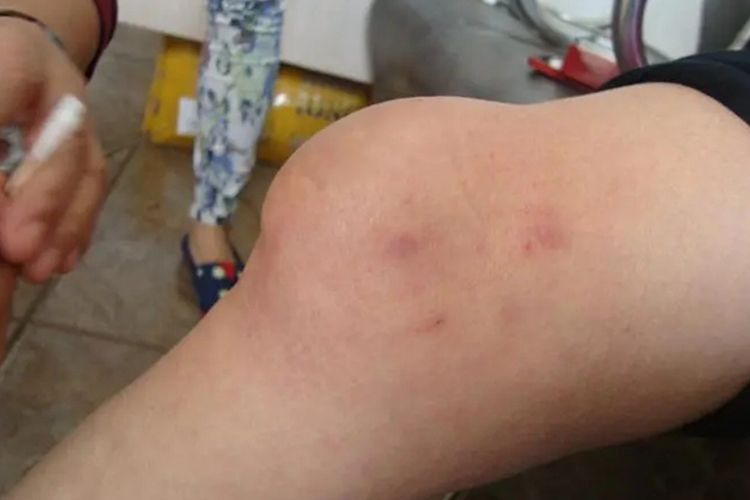 膝盖积液局部肿胀图