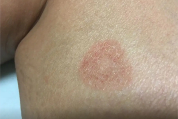 红斑性皮肤松弛症腿部红斑图