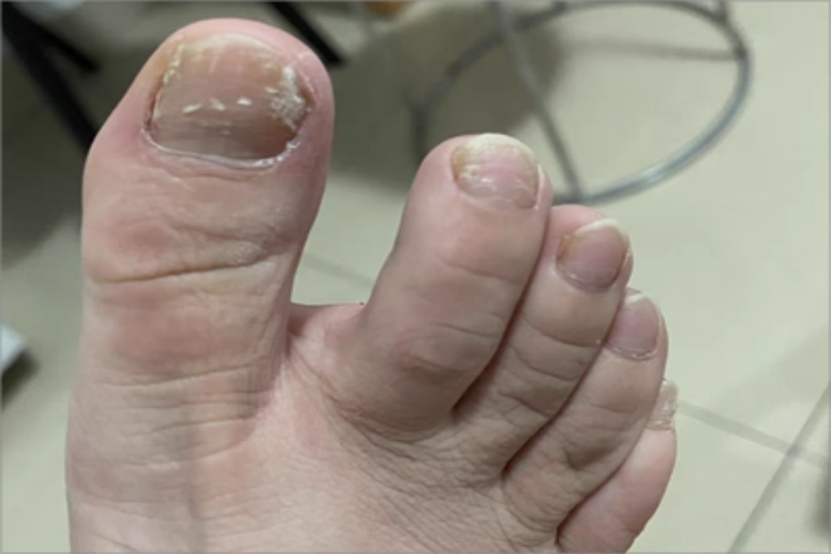 白色浅表型甲真菌病脚趾甲竖纹图