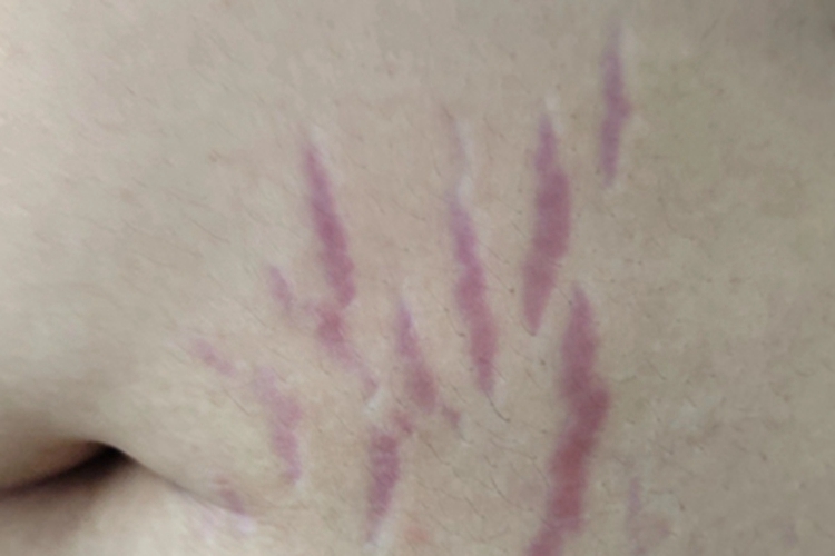 萎缩纹左腹紫红色条纹图