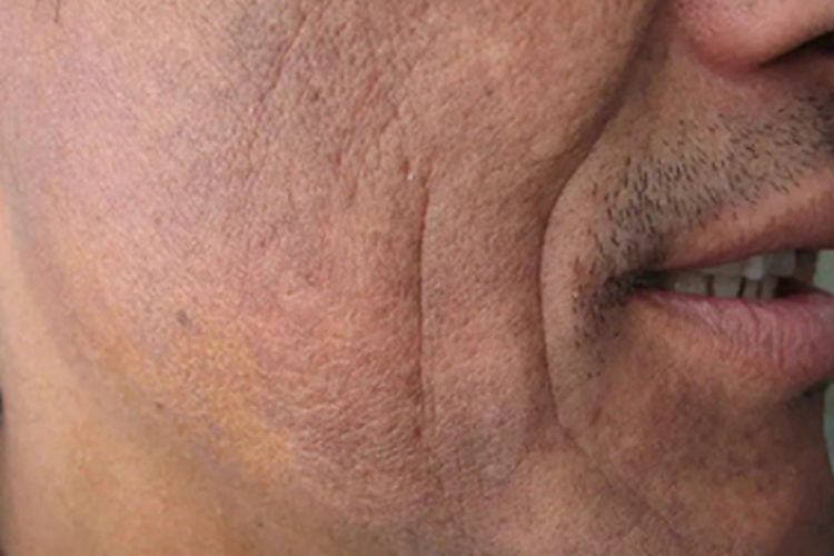 职业性黑变病面部症状图 职业性黑变病面部症状图