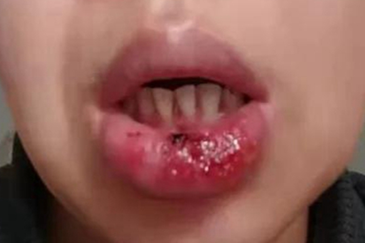 急性光化性唇炎肿糜烂图