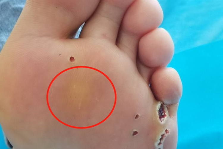 跖疣创面干燥图