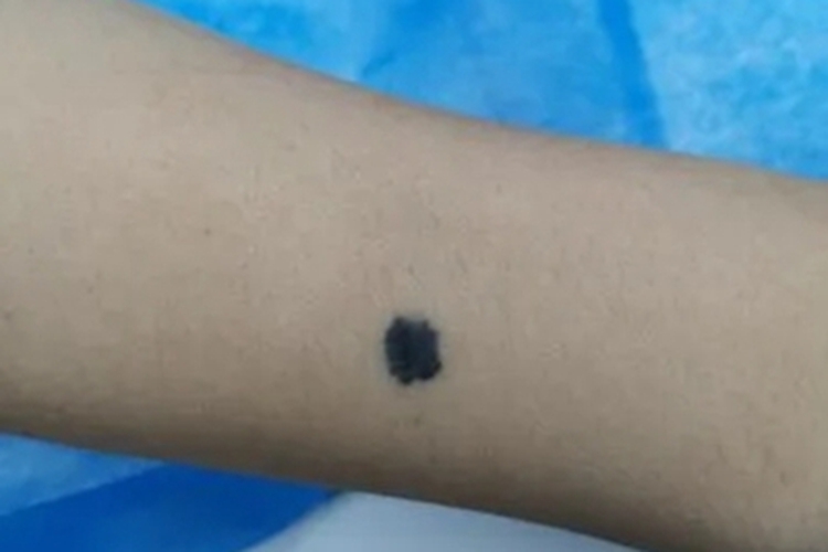 细胞蓝痣胳膊症状图