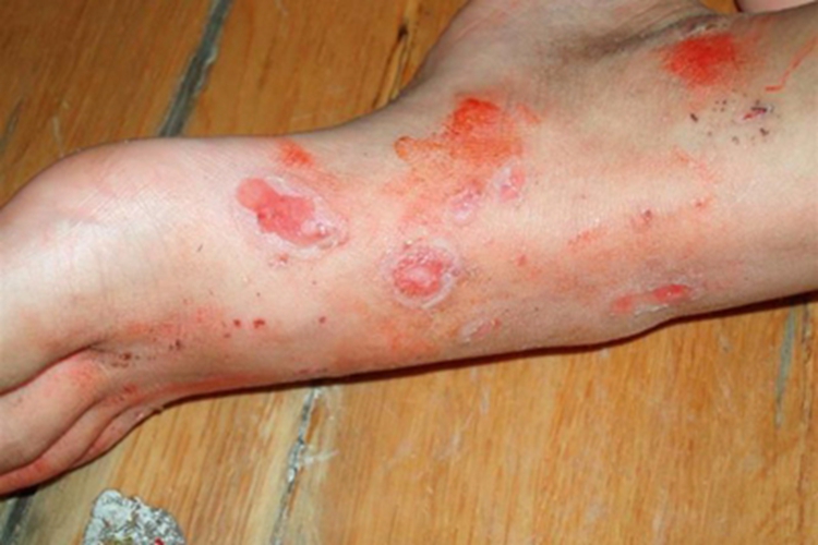 脓窝疮脚背症状图 脓窝疮脚背症状图