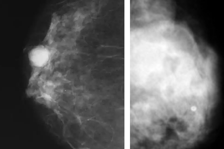 乳腺癌与乳腺囊肿影像对比图