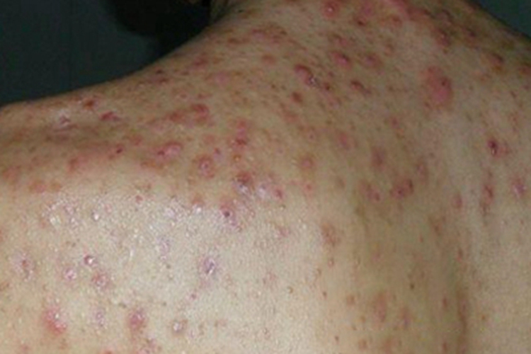 聚合性痤疮背部大红疙瘩图