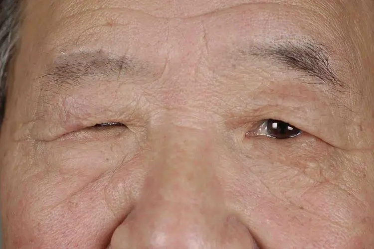 眼角下垂图片