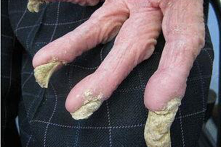 结痂性疥疮手指甲症状图 结痂性疥疮手指甲症状图