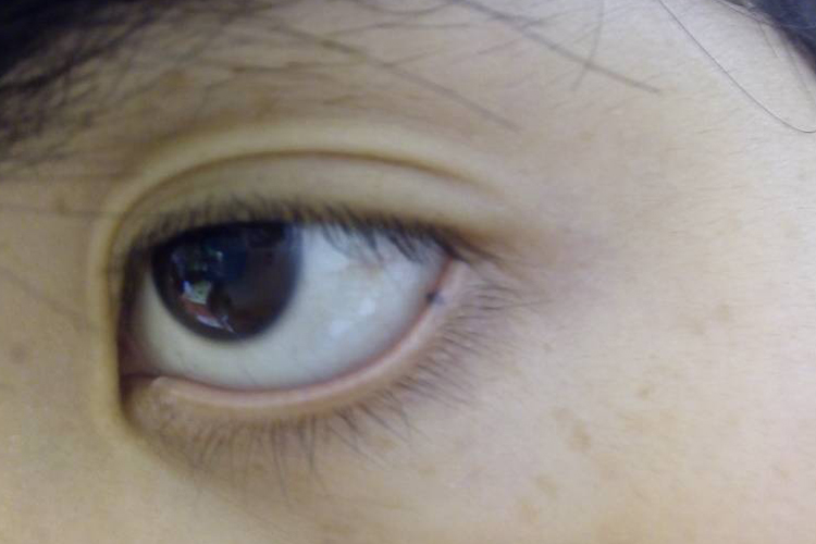 下眼皮翻开有小黑点图 下眼皮翻开有小黑点图