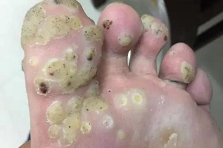 寻常疣脚底小疙瘩图