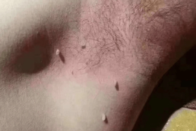腋窝尖锐湿疣早期图