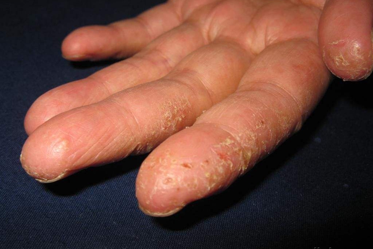 手部角化性掌部湿疹图