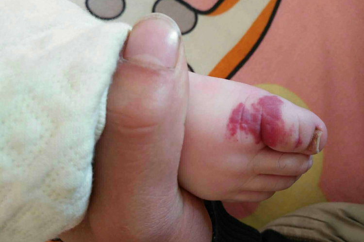 大脚趾海绵状血管瘤图