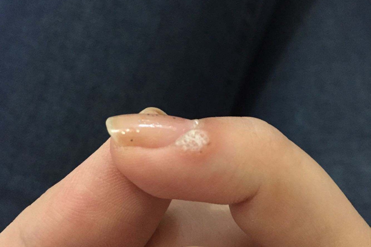 甲周疣图 甲周疣图