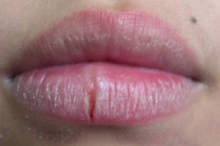 接触性唇炎嘴唇裂开图
