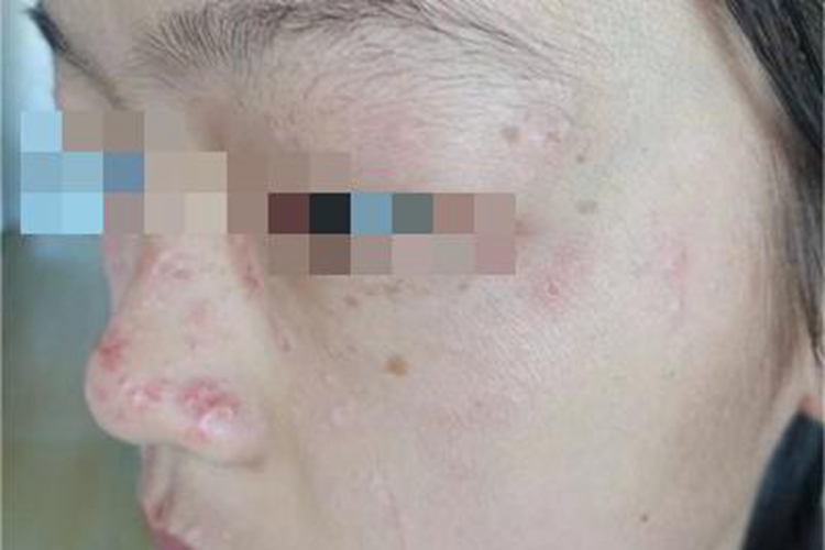 急性皮肤型红斑狼疮丘疹图