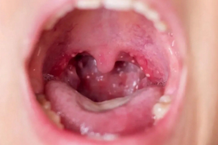 咽峡炎咽喉水疱图 咽峡炎咽喉水疱图