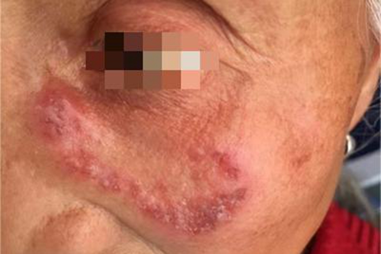 急性皮肤型红斑狼疮面部红斑图