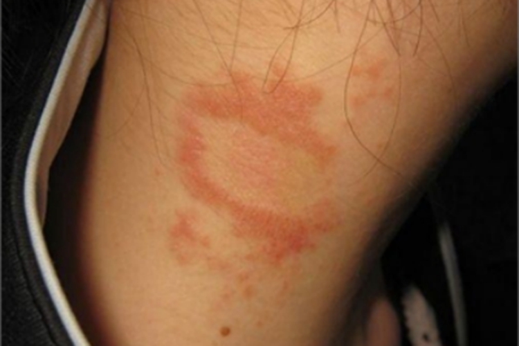 体癣颈部红斑图