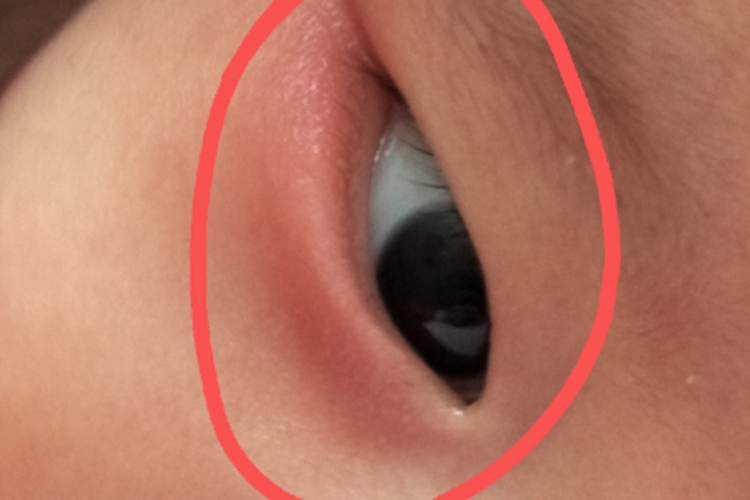 宝宝眼角发红图