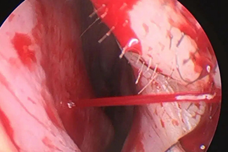 鼻黏膜糜烂发炎图