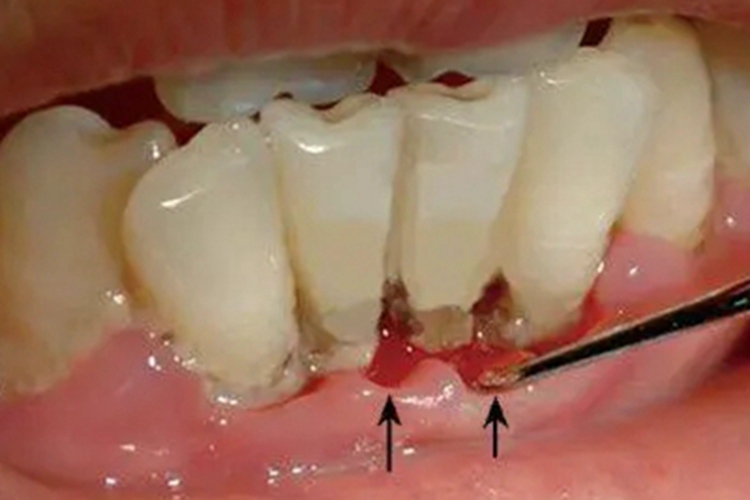 急性坏死性龈口炎牙龈糜烂图
