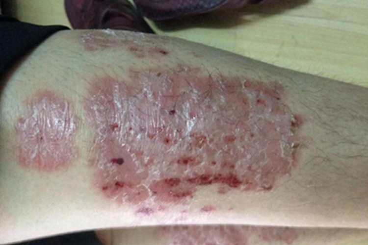 寻常型银屑病小腿鳞屑图