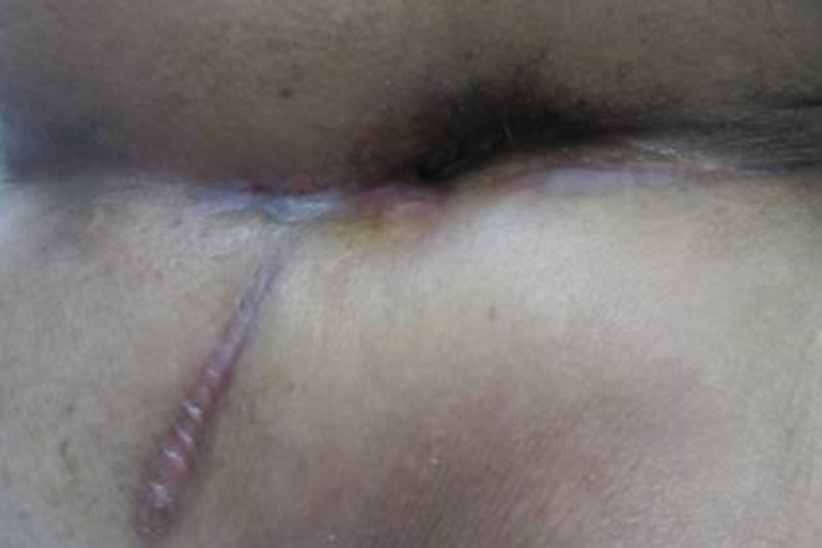 肛周脓肿术恢复图