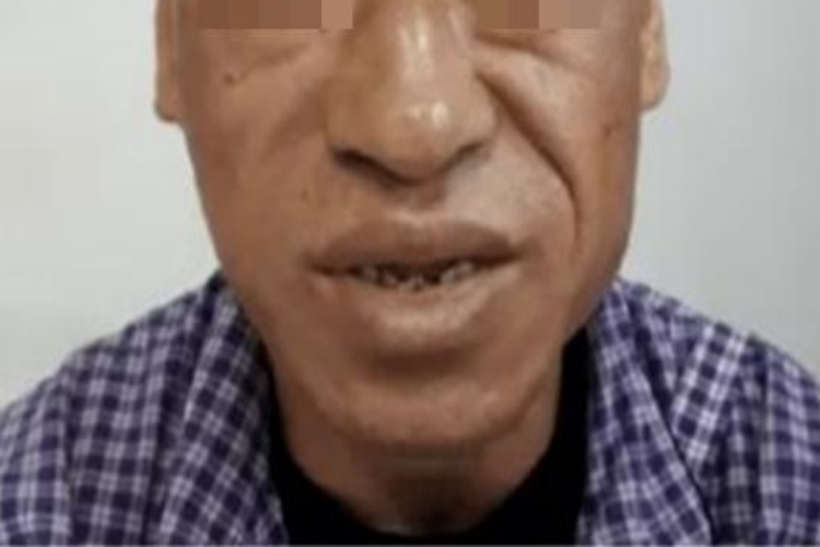 肢端肥大症面部症状图