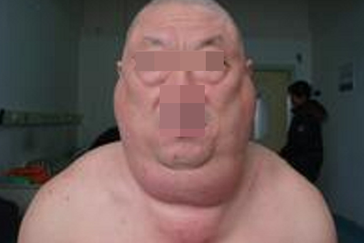 良性对称性脂肪过多症面部症状图