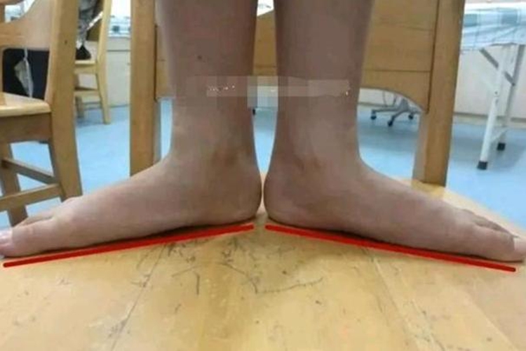 扁平足图 扁平足图