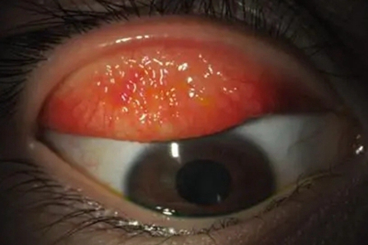 巨乳头性结膜炎小疙瘩图