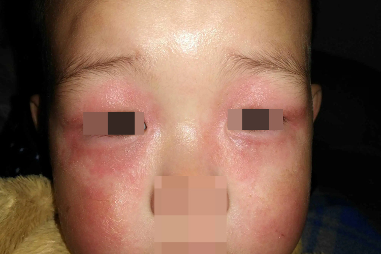 亚急性湿疹眼周红斑图 亚急性湿疹眼周红斑图