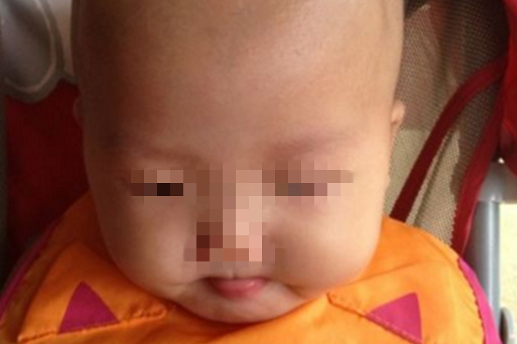 宝宝头两侧骨头突出图